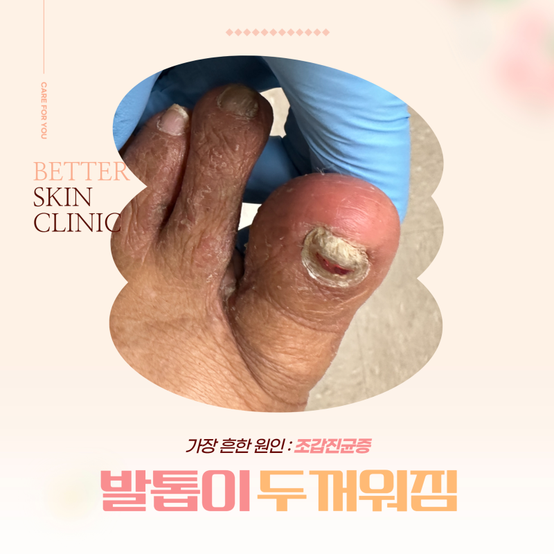 발톱이 두꺼워짐 가장 흔한 원인 : 조갑진균증