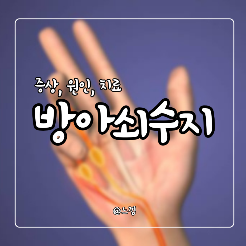 방아쇠수지증후군 원인 증상 치료 스트레칭
