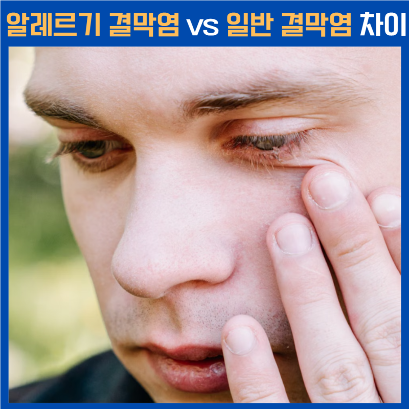 알레르기 결막염 vs 일반 결막염 차이, 눈 가려움·충혈로 구별할 수 있을까?