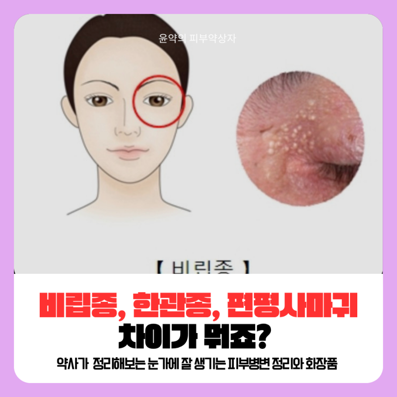 눈 밑에 요철 그건 바로, 한관종 vs 비립종 vs 편평사마귀 비교 정리와 사용하면 안되는 성분