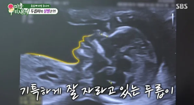 김지민 시험관 임신 성공, 배아이식 후 임신 성공확률은? 40대 시험관 시술의 현실