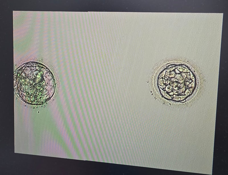 [동결 2차] 1탄 쌍둥이 소파술 후 다시 5일 배아 이식 과정·비용(+유산후 바우처)