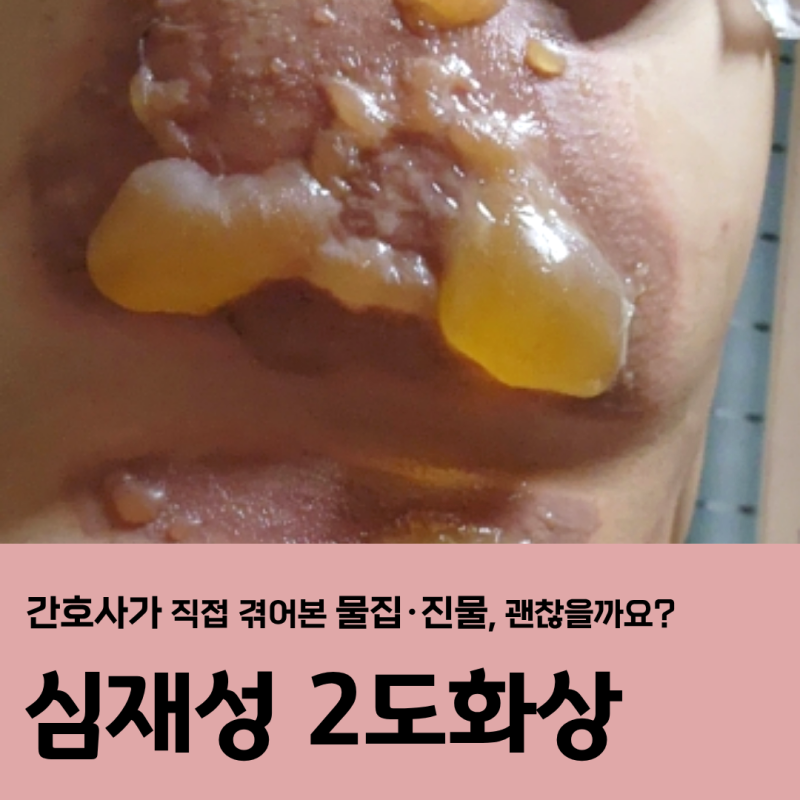 심재성2도화상, 물집에 진물까지 나는데 괜찮은 걸까요?(실제 경과 사진)