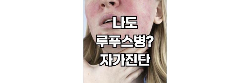 루프스 유행의 오해! 감염병일까? 증상 의심될 때 병원은 어디 가야 할까?