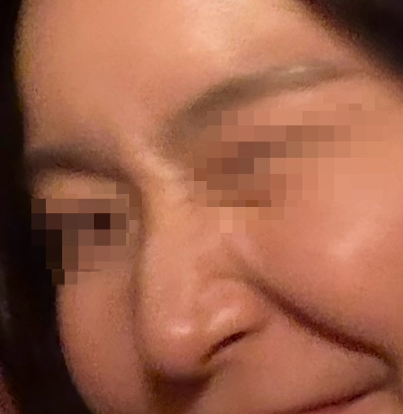 기능코+미용코+메부리코 수술 찐후기 | 부작용까지 솔직하게 (부목 뗀 7일차) | 긴글 주의