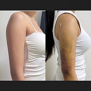 분당 팔뚝람스 당일~1주차 솔직후기, 통증·붓기부터 팔뚝살 라인 변화까지