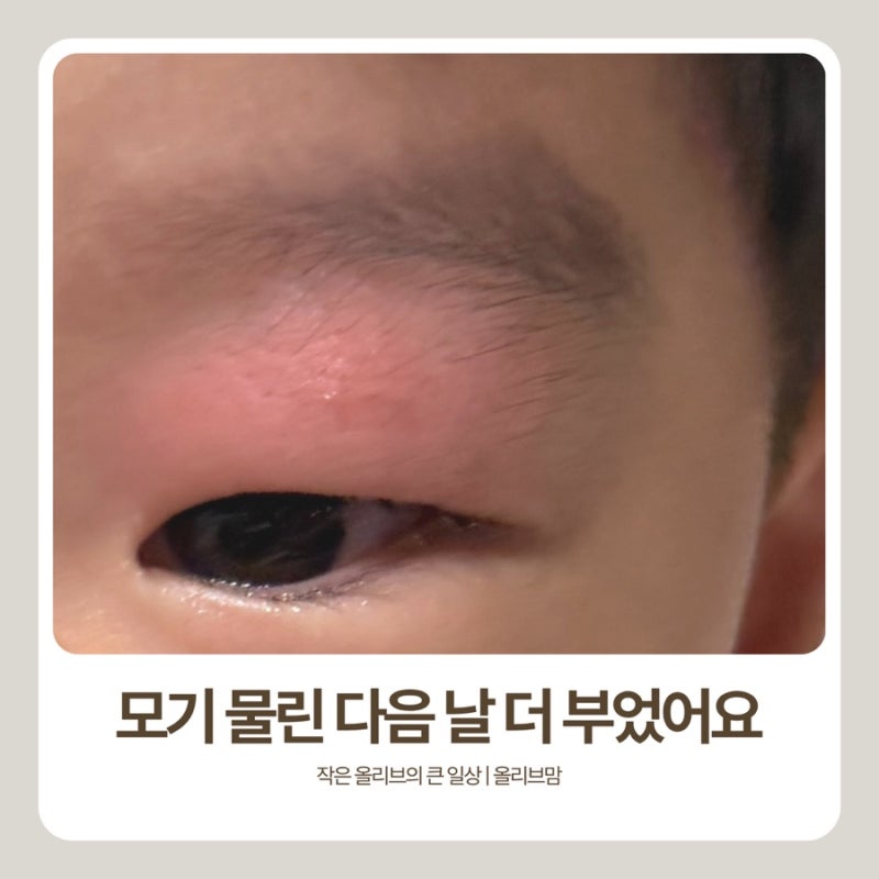 아기 모기 물렸을때 대처 | 연고 가려움 붓기 스키터증후군