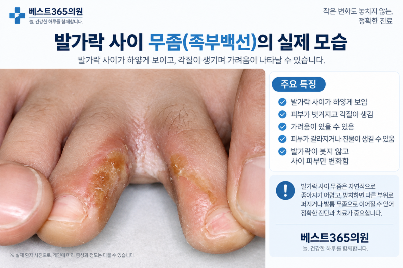 발가락 사이가 가렵고 벗겨져요, 습진일까요 무좀일까요?