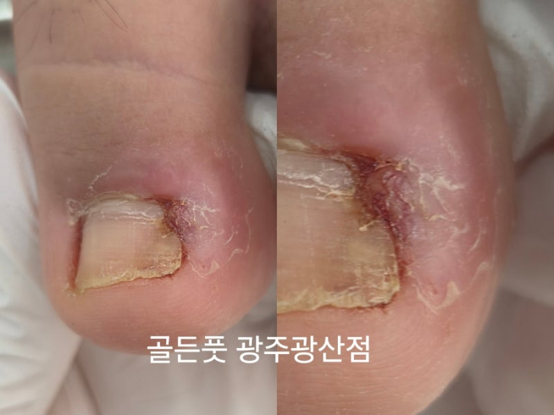 광주내성발톱. 병원 관리를 여러차례 받았지만, 발톱이 길러 나올때마다 다시 찾아오는 육아....