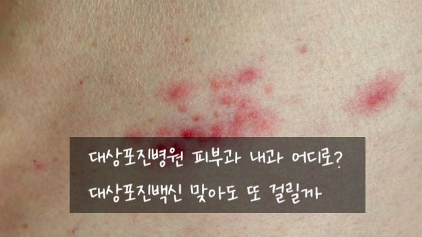 대상포진병원 피부과 내과 어디로? 대상포진백신 맞아도 또 걸릴까