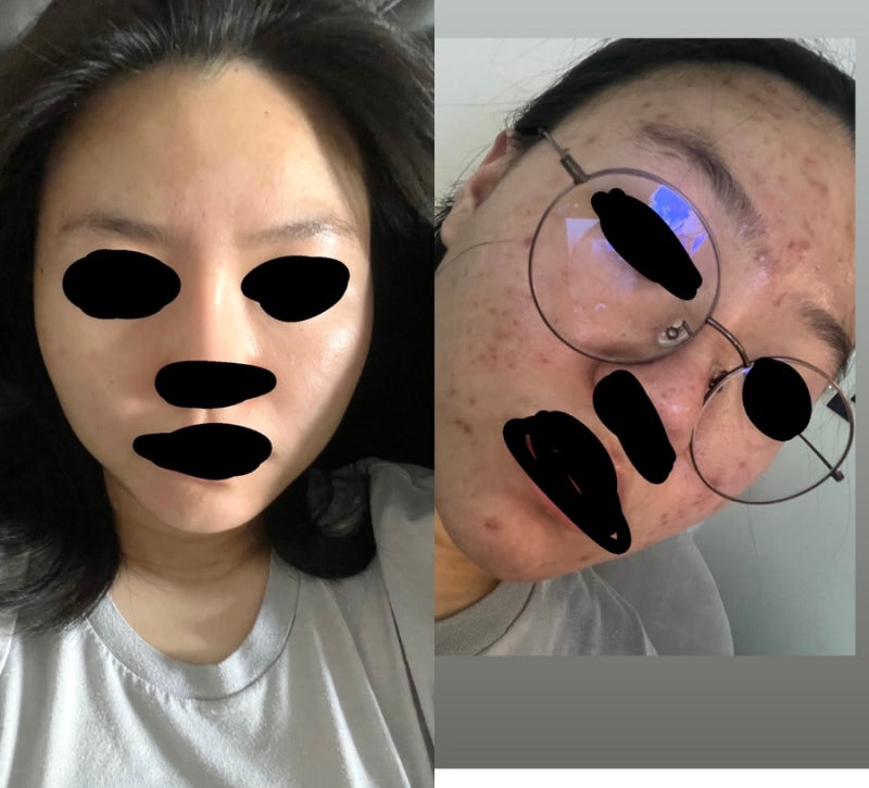 제1장 이소티논 후기(4개월 복욕중)