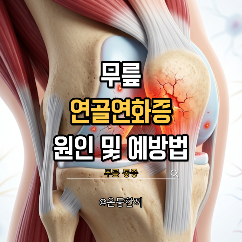 무릎 연골연화증 증상 통증 운동법