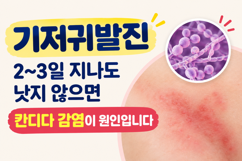 기저귀발진 — 2~3일 지나도 낫지 않으면 칸디다 감염이 원인입니다
