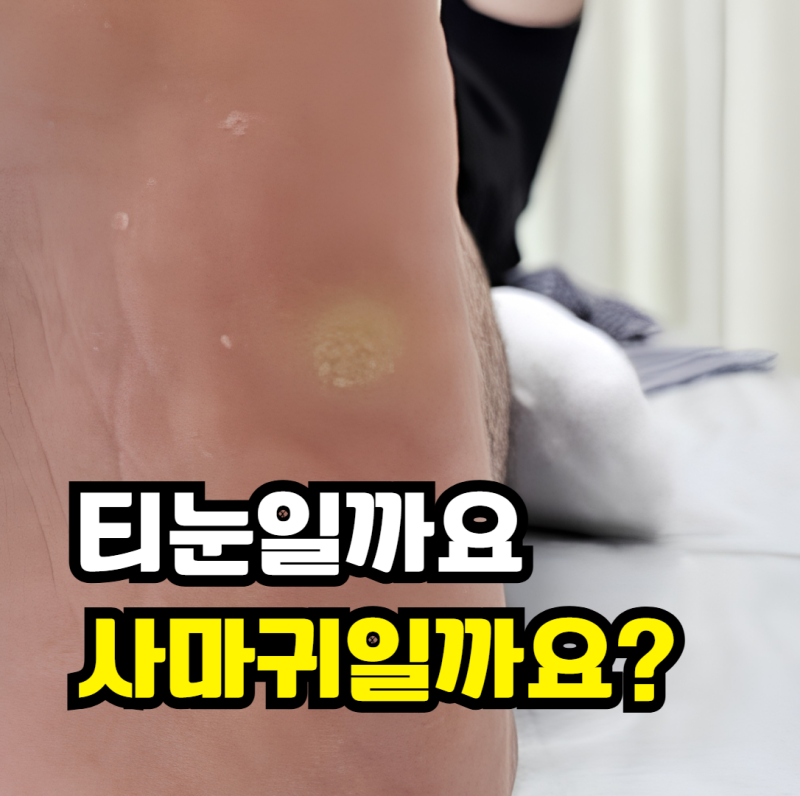 발바닥 사마귀 티눈 구분, 어떻게 하면 될까요?