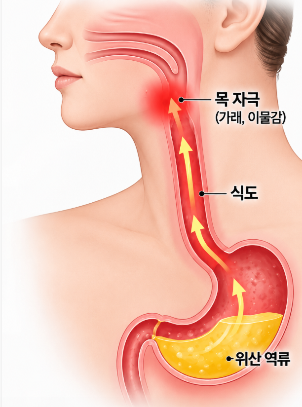 목에 가래 낀 느낌 몇 주째 안 없어져 "그냥 가래"겠지하고 넘겼는데... 내가 들은 의외의 "병....