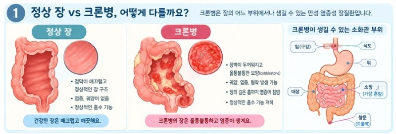 소아 크론병 (우리 아이의 반복되는 복통과 설사, 그냥 장염일까요?)