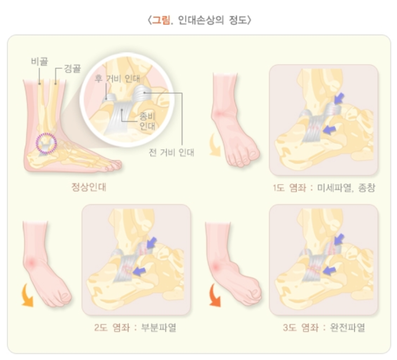 [시화병원 메디프렌즈 서포터즈 1기 활동] 발목을 삐끗했는데 며칠째 붓는다면? 단순 염좌와 ....