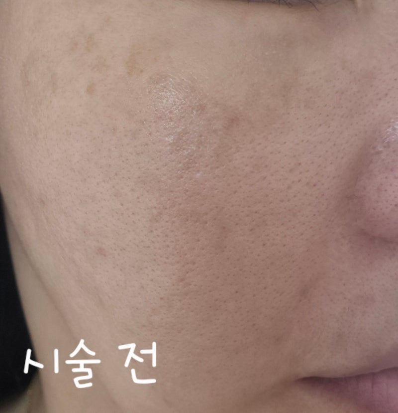 (내 돈 내산)피부 잡티제거 피코토닝 레이저 후기! (통증부터 3일 차 경과까지)