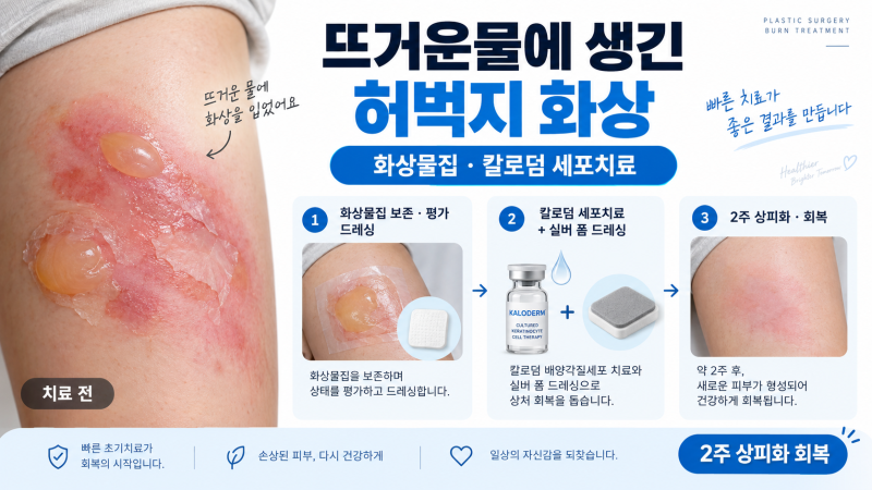 뜨거운물 허벅지 2도 화상, 화상물집부터 칼로덤 세포치료, 화상흉터관리방법까지