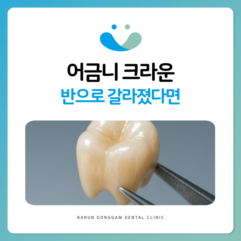 간석동치과 질긴 갈비를 뜯다가 어금니 크라운이 반으로 갈라졌다면 바로 병원에 가야 할까....