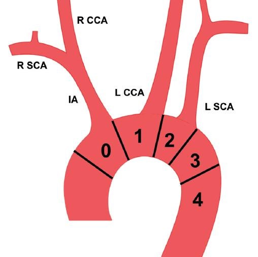 TEVAR (Thoracic Endovascular Aortic Repair) 흉부 대동맥 혈관 내 스텐트 그라프트 삽입술