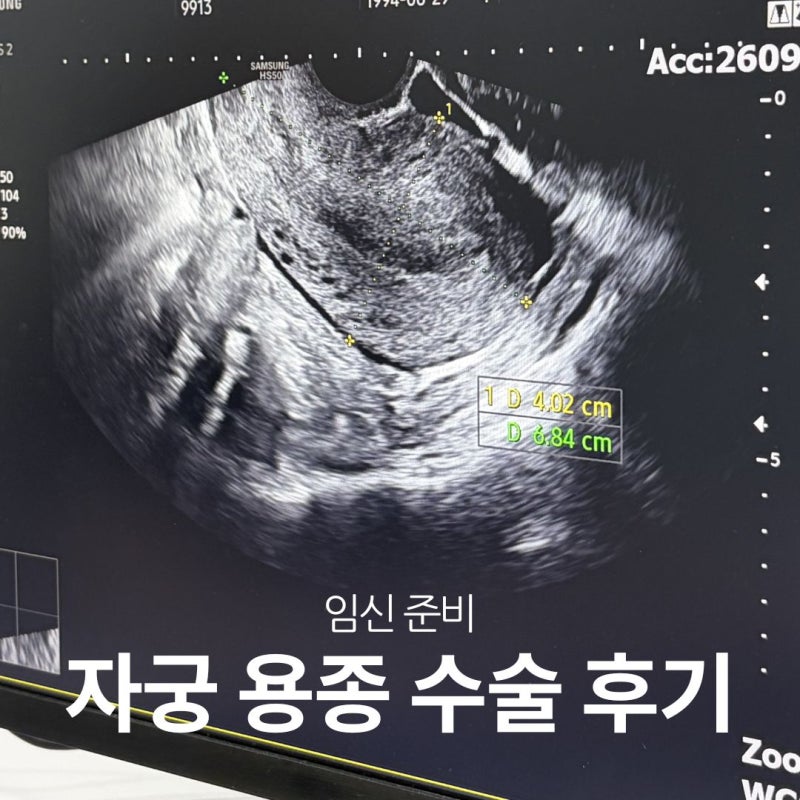 자궁경을 통한 용종 수술 후기 (Feat. 보험서류)