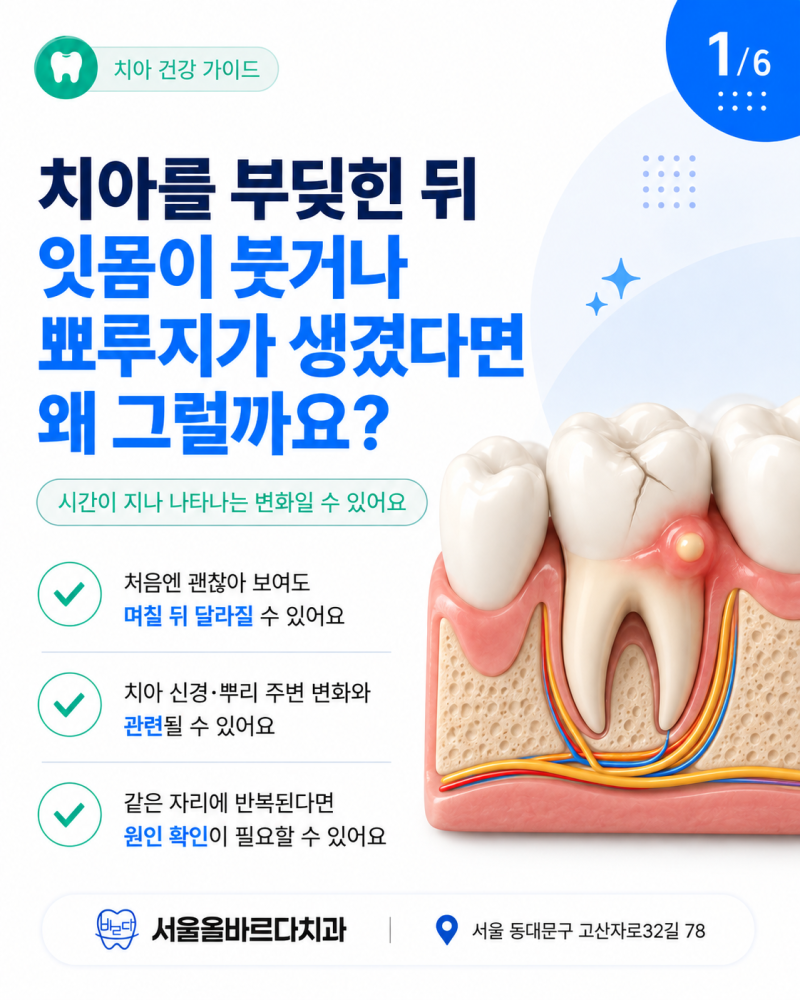 수유역치과 치아를 부딪히고 나서 잇몸에 뾰루지가 생겼다면 확인해보세요