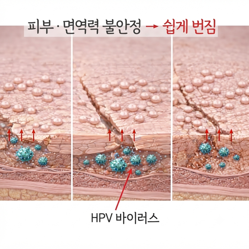 범계 편평사마귀 / 원장이 알려주는 재발 시 관리, 제거 방법은?