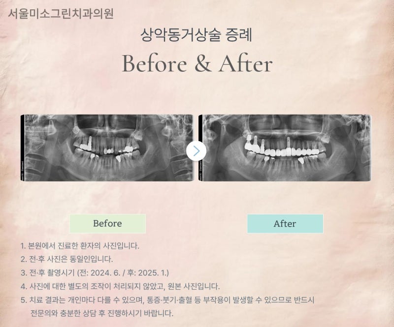 [ 신사동 치과 ] 잇몸뼈 부족, 치조골이식술이 필요한 이유는 뭘까? 임플란트 뼈이식과 상악....