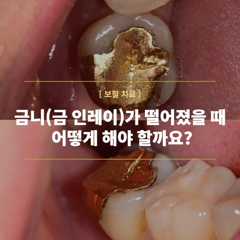 금니(금 인레이)가 떨어졌을 때 어떻게 해야 할까요? — 다시 붙였는데 또 떨어진 어금니, 크....