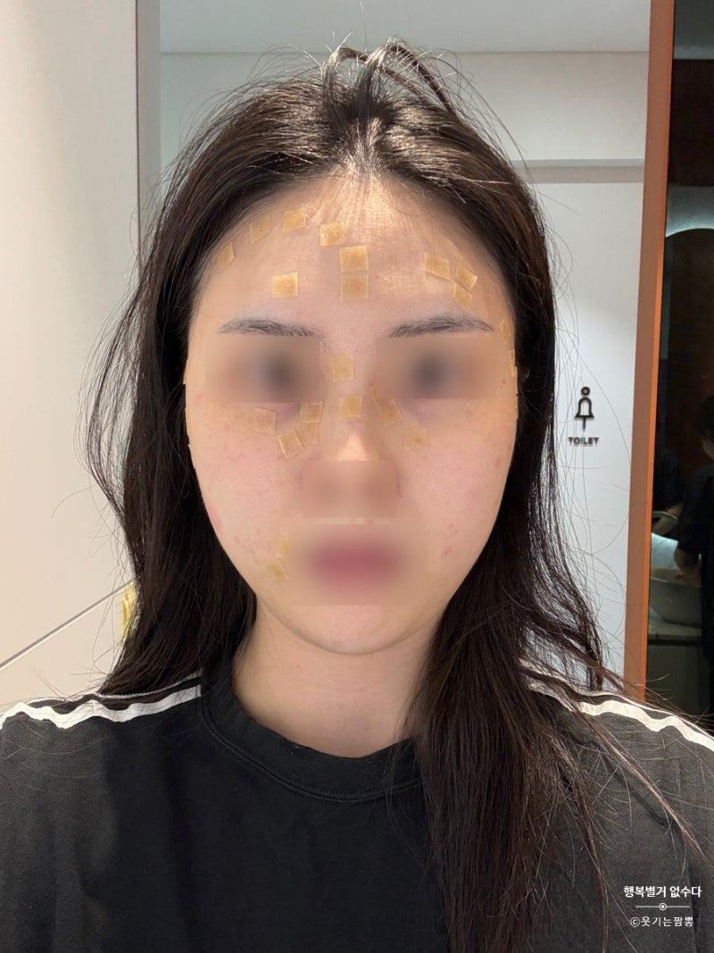 대구 편평사마귀, 점, 쥐젖, 잡티 제거 성지 한의원 비용 통증 내돈내산 후기 1️⃣탄, 광고X (....