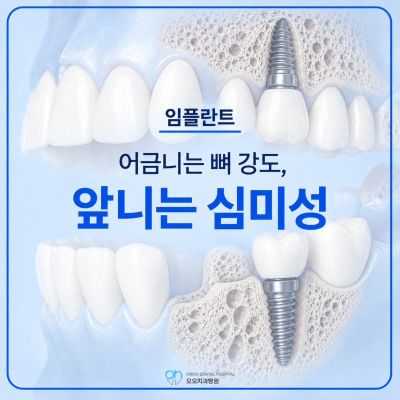 임플란트, 앞니와 어금니 위치별 선택 기준