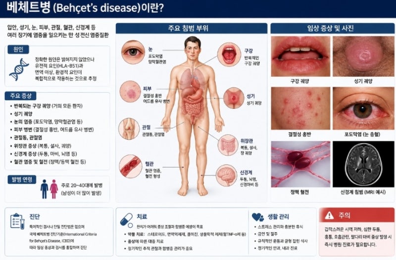 베체트병의 증상과 원인 치료방법