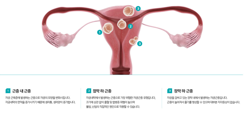 자궁근종 크기 '이런 경우' 수술할 필요 없다? 1cm 2cm 3cm