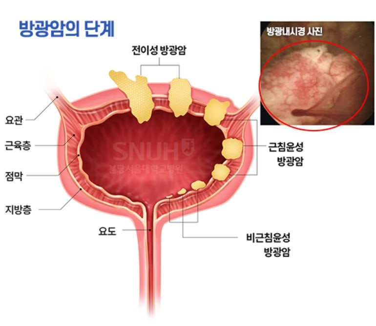 방광암 초기증상, 생존율, 방광암에 좋은 음식
