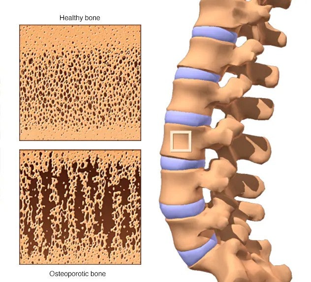 골다공증 Osteoporosis: 뼈는 왜 조용히 무너질까요?