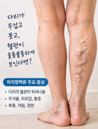 하지정맥류 실손보험, 9월부터 달라집니다…입원했다고 다 받는 게 아닙니다