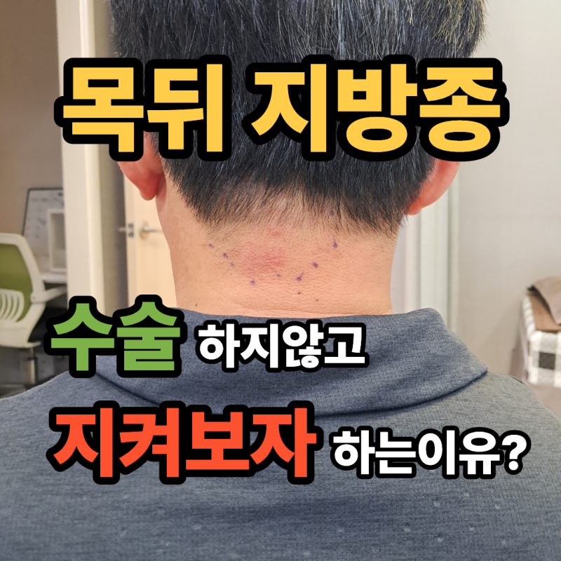 두피·목 지방종, 병원에서 수술하지 않고 지켜보자 하는 이유