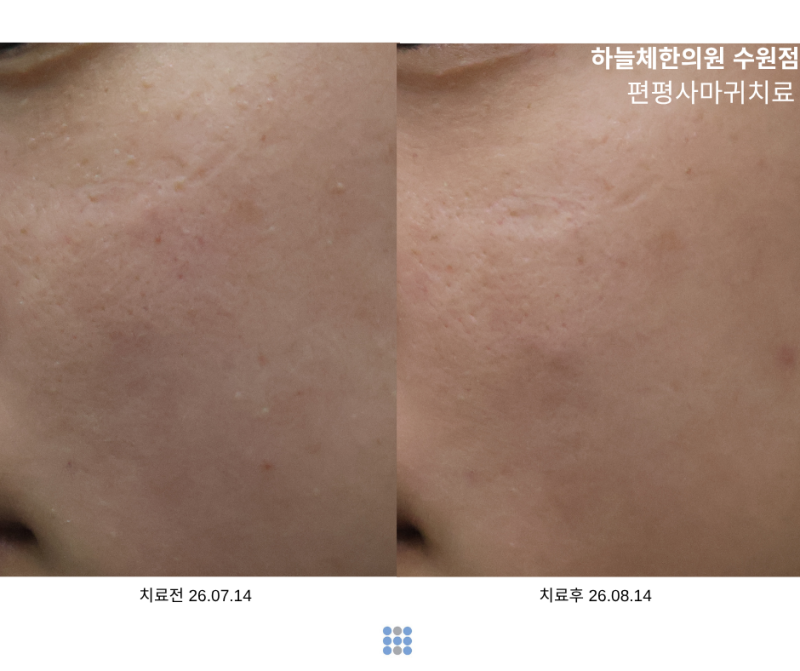 편평사마귀 제거 후 다시 생긴 것처럼 보이는 이유