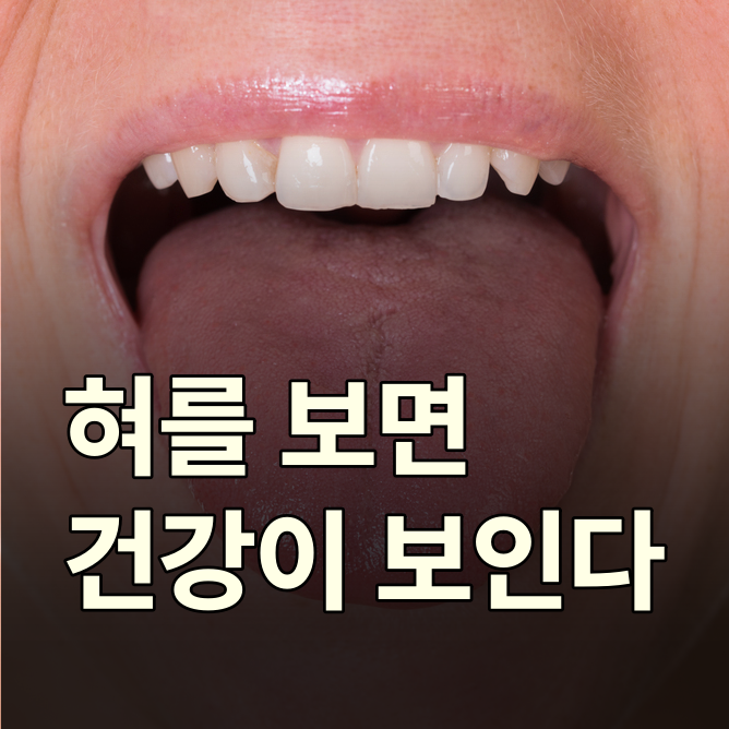 혀갈라짐, 병 아니라는데 왜 아플까 (혀염증 원인까지)