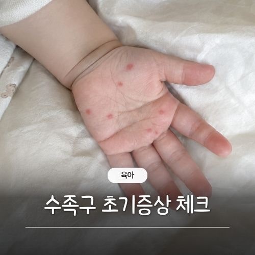 아기 수족구 초기 증상 손바닥 붉은반점, 무조건 수족구일까?