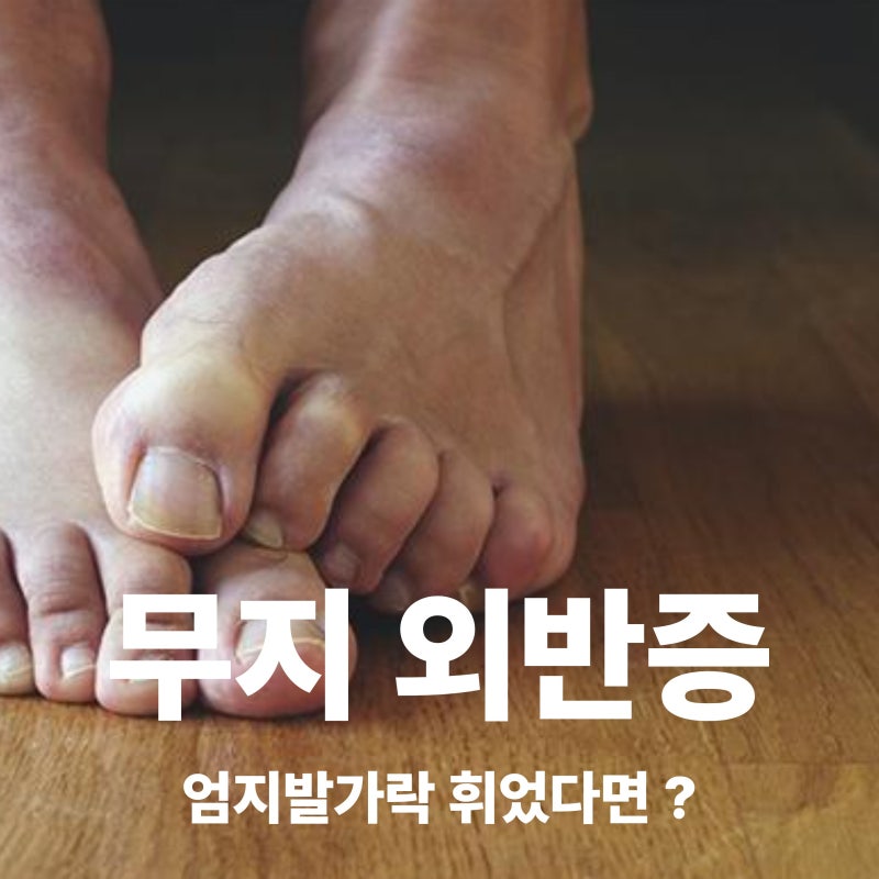 무지외반증 증상과 원인, 엄지발가락 통증과 변형 알아보기