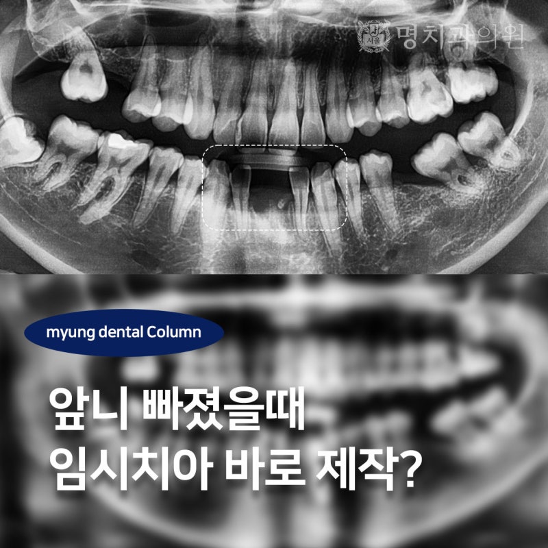 앞니 빠졌을때 원데이 임시치아 바로 제작할수 있을까?