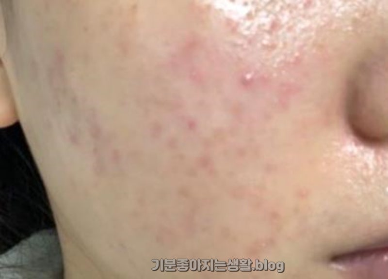 얼굴 접촉성 피부염 증상 리도맥스 0.3 효과 제일 괜찮았던 관리법