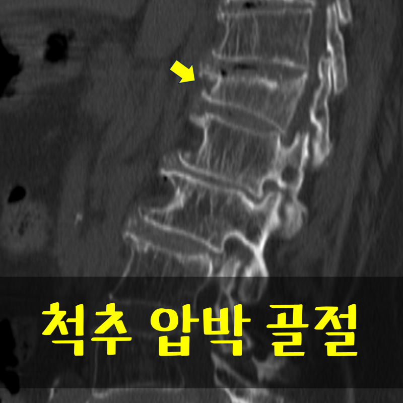 척추 압박골절 보조기, 누워있을 때도 착용할까?