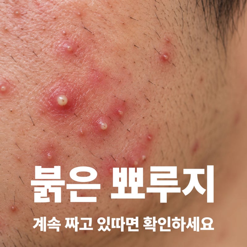 모낭염 증상과 원인, 여드름처럼 보이는 붉은 뾰루지가 생긴다면