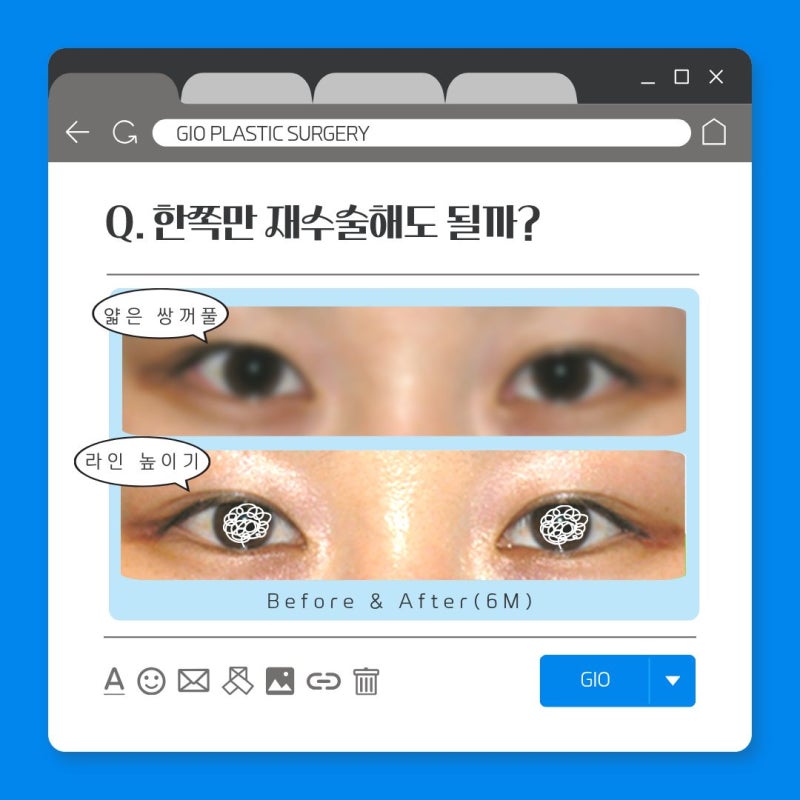 쌍수 재수술 후기 짝눈 대칭 위해 다시 수술 했을때