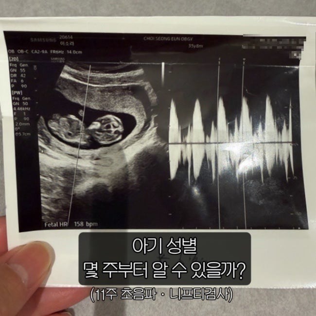 아기 성별 확인 가능한 주수는 언제?｜11주 니프티검사와 초음파성별맛집 최성은 산부인과 ....