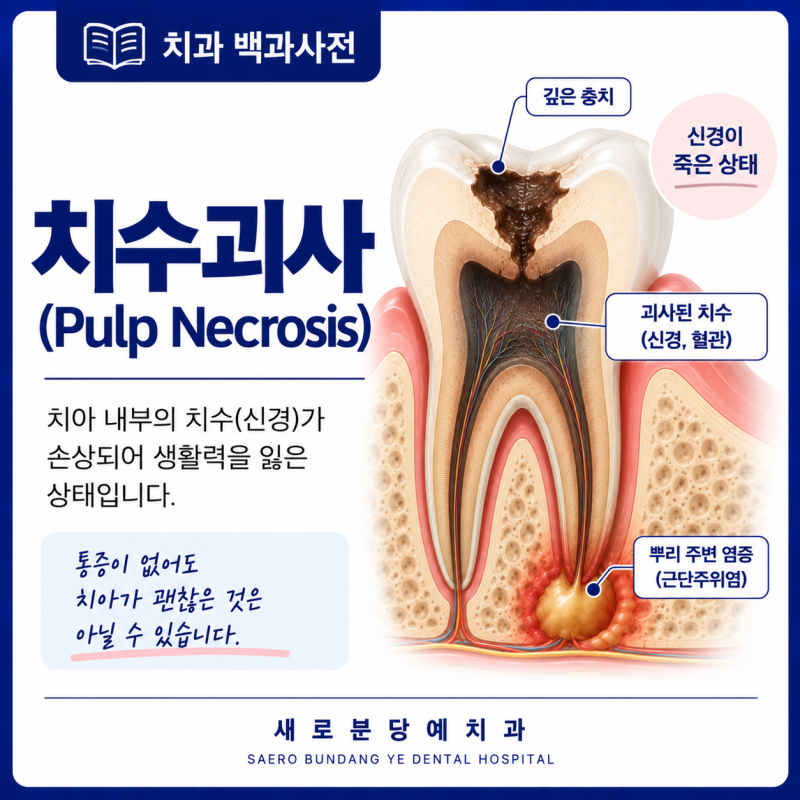 치수괴사(Pulp Necrosis)란?