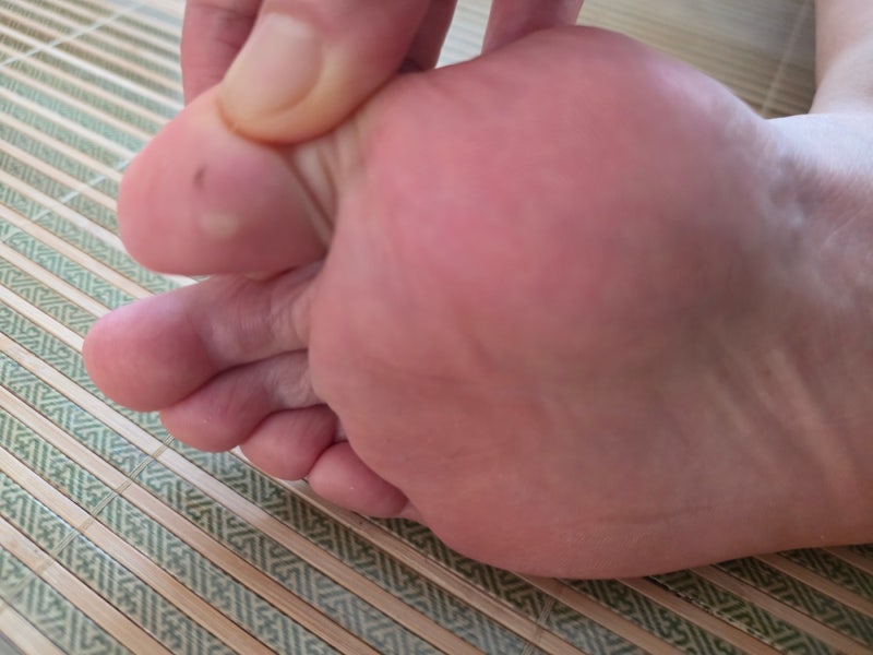 러닝 후 발에 생긴 물집, 다이소 물집밴드(습윤밴드) 붙여봤더니?